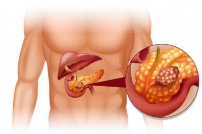 Phát hiện hợp chất ở loài cây nhiệt đới chữa khỏi ung thư tuyến tụy