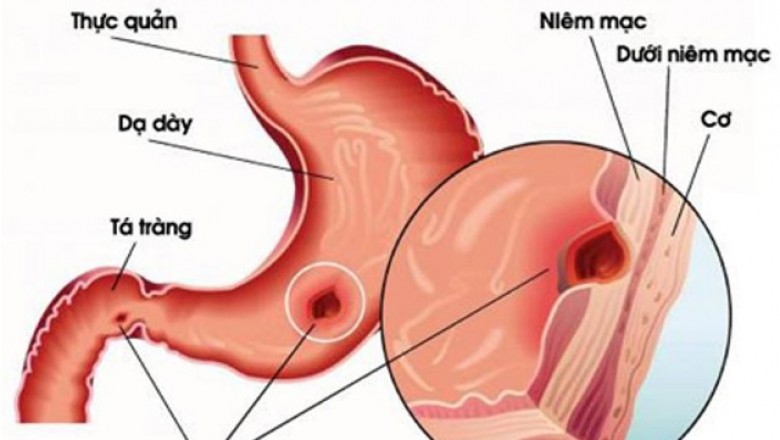 Thảo dược trị viêm dạ dày tá tràng từ cây Chè dây, cây Dạ cẩm, Bạch truật 