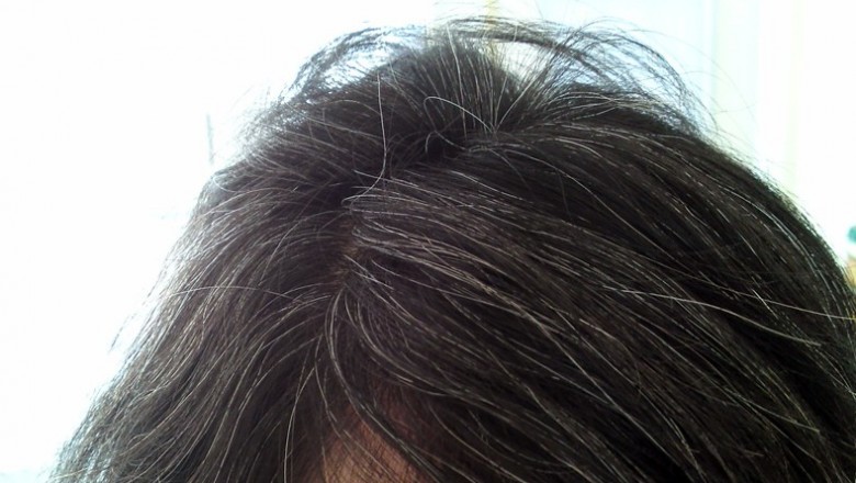 Bệnh tóc bạc sớm là gì? Xem thêm thực phẩm phòng bệnh Tóc Bạc Sớm