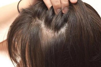 Tóc bạc sớm ở nữ giới là gì, nguyên nhân và cách trị tóc bạc sớm đơn giản tại nhà bằng Thảo dược