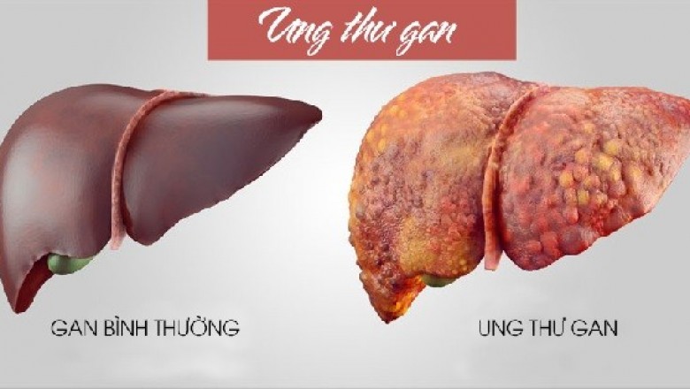 Những dấu hiệu báo động ung thư gan