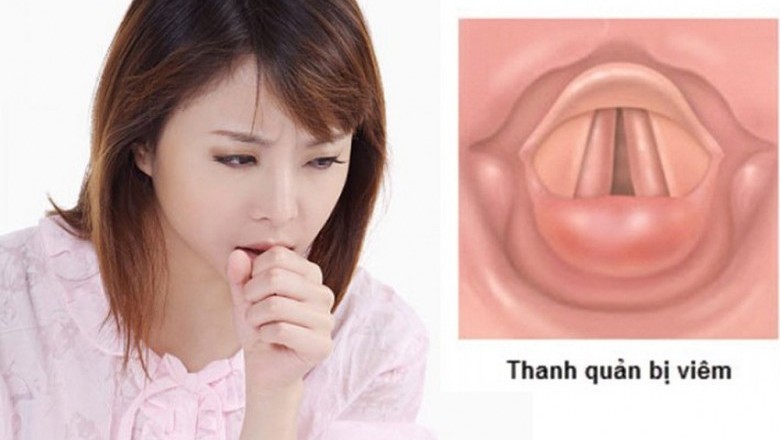 Bài thuốc trị bệnh viêm thanh quản