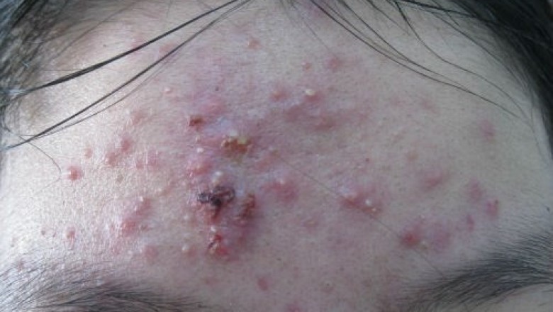 Y học cổ truyền điều trị mụn trứng cá