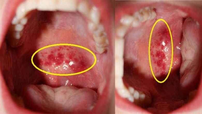 Bài thuốc trị viêm họng, thanh quản
