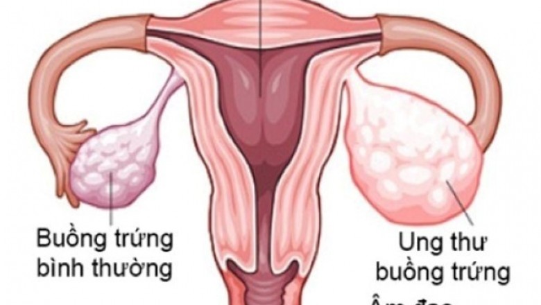 Dấu hiệu cảnh báo sớm ung thư buồng trứng