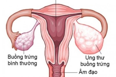 Dấu hiệu cảnh báo sớm ung thư buồng trứng