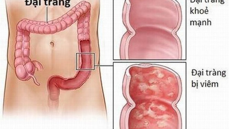 Bài thuốc hay chữa bệnh viêm đại tràng
