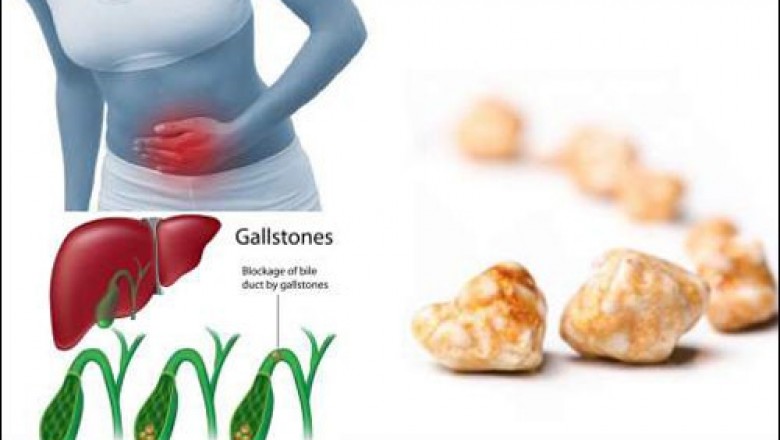 Cách điều trị bệnh sỏi túi mật hiệu quả