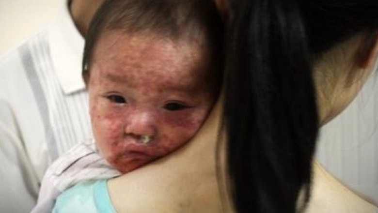 Bài thuốc nam hỗ trợ điều trị bệnh sởi