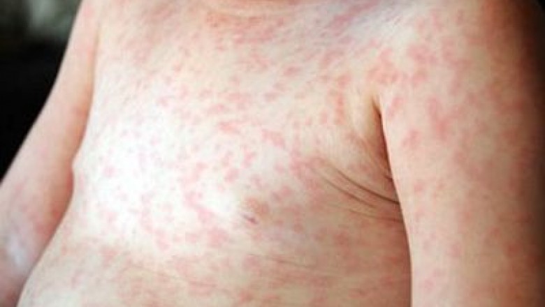 Bệnh sởi là gì, triệu chứng và cách điều trị bệnh