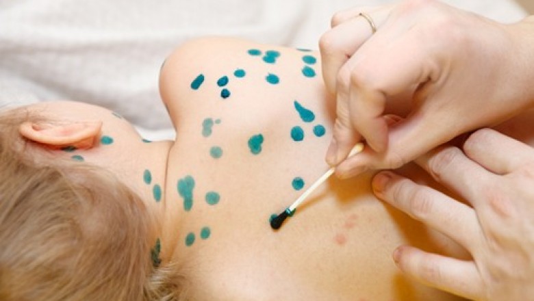 Bài thuốc Y học cổ truyền phòng và trị bệnh thủy đậu