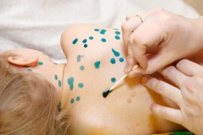 Bài thuốc Y học cổ truyền phòng và trị bệnh thủy đậu