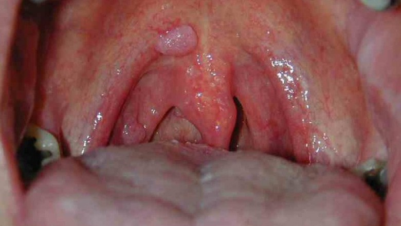 Dấu hiệu cảnh báo ung thư tai mũi họng