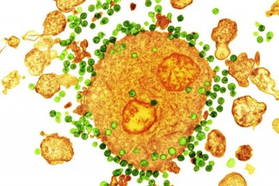Bệnh nhân thứ hai trên thế giới được chữa khỏi HIV
