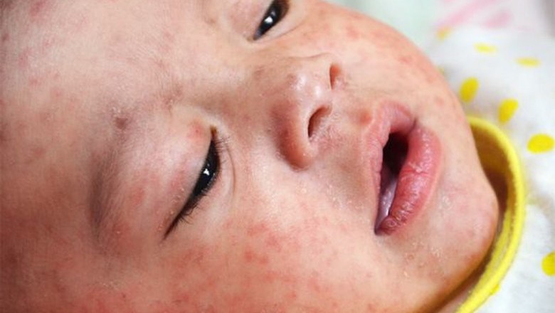 Bài thuốc dành cho trẻ em bị bệnh sởi