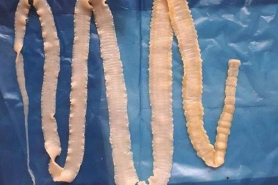 Nguyên nhân, triệu chứng và cách phòng chống bệnh sán lợn gạo