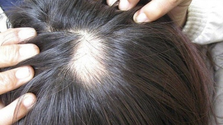 Nguyên nhân thực sự của bệnh rụng tóc nhiều người đang mắc phải