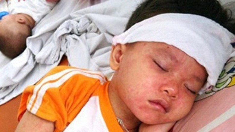 Tại sao virus sởi lại đặc biệt nguy hiểm cho trẻ sơ sinh?