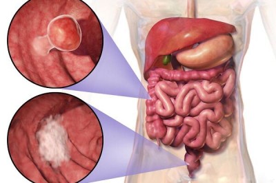 Những dấu hiệu cảnh báo bệnh Ung thư ruột có thể bạn đang mắc bệnh