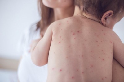 Bệnh sởi tăng cao trên thế giới những tháng đầu năm 2019