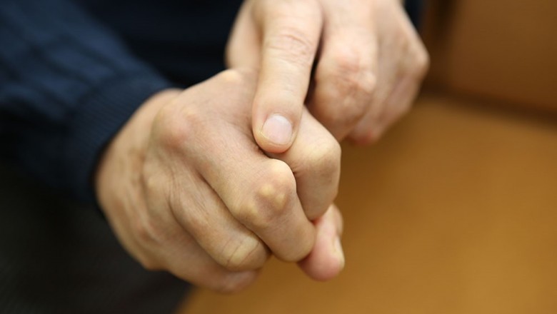 Triệu chứng, nguyên nhân, điều trị, phòng ngừa bệnh Gout