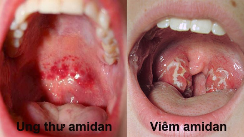 Làm thế nào để phân biệt ung thư amidan và viêm amidan?