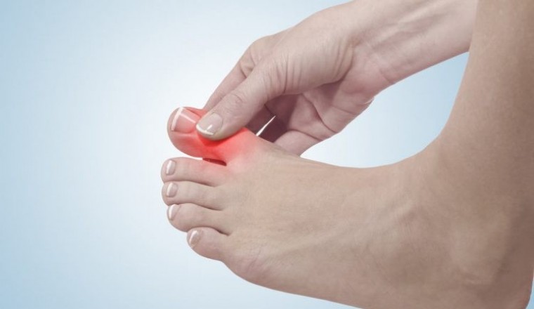 Chế độ ăn cho người bệnh gút, người mắc bệnh gút ăn gì tốt?
