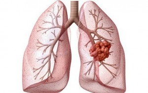 Tiềm năng mới trong điều trị ung thư phổi