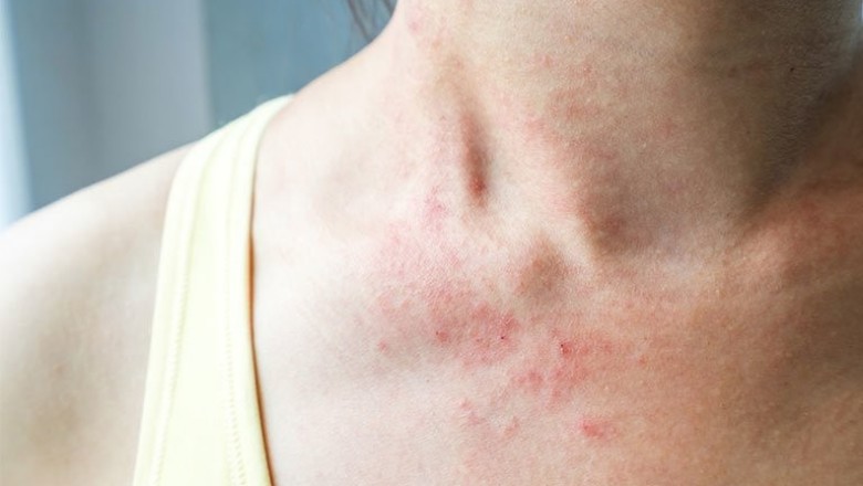Nguyên nhân và cách điều trị viêm da dị ứng