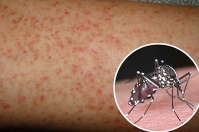 Sốt xuất huyết nên ăn gì để bệnh nhanh khỏi, tránh biến chứng