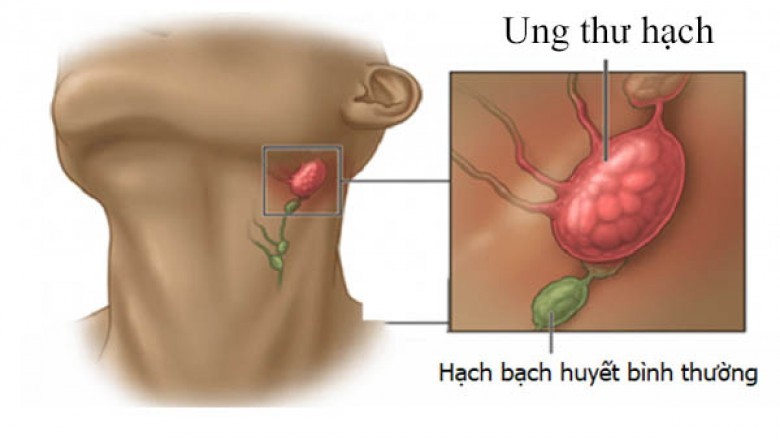 Những lưu ý về ung thư hạch bạch huyết