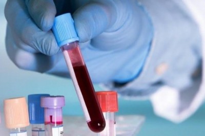 Nghiên cứu mới: Người có nhóm máu A dễ mắc Covid-19