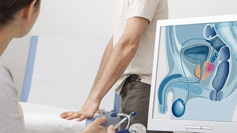 Những điều cần biết về ung thư tuyến tiền liệt