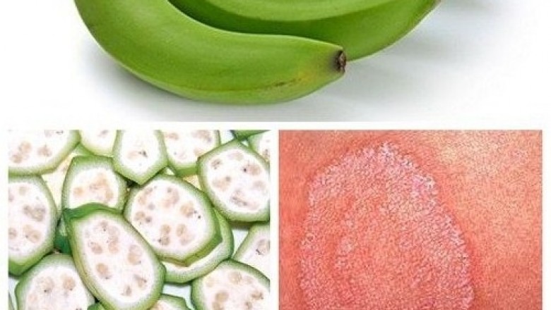 Nhựa quả chuối xanh có trị được giời leo?