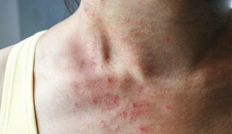 5 loại thực phẩm gây viêm nhiễm cho cơ thể