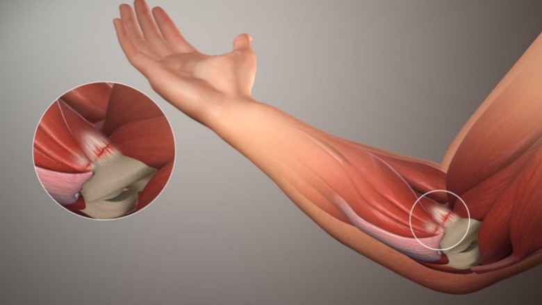 Đau khớp khuỷu tay: Nguyên nhân và cách xử trí