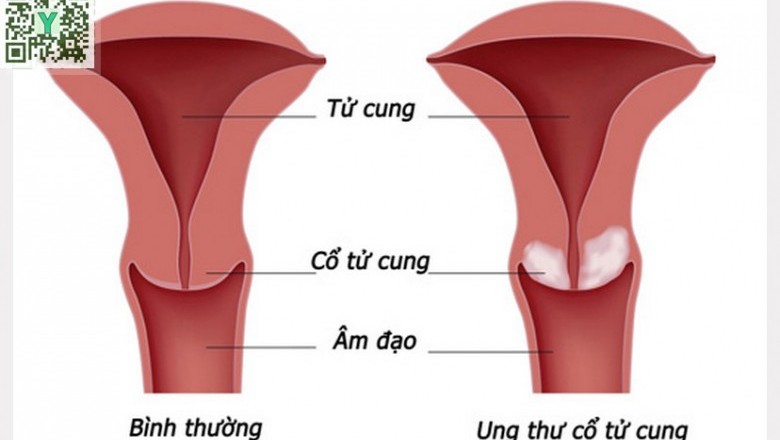 7 dấu hiệu ung thư cổ tử cung nguy hiểm, chị em nhất định không được bỏ qua