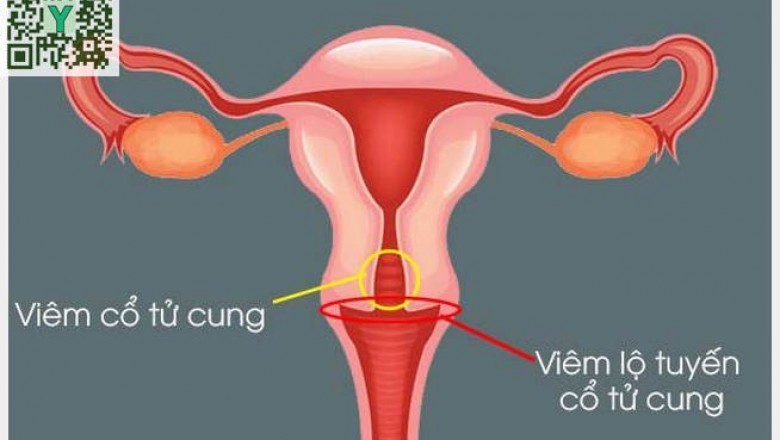 Bệnh viêm lộ tuyến cổ tử cung: 4 dấu hiệu nhận biết bệnh viêm lộ tuyến cổ tử cung