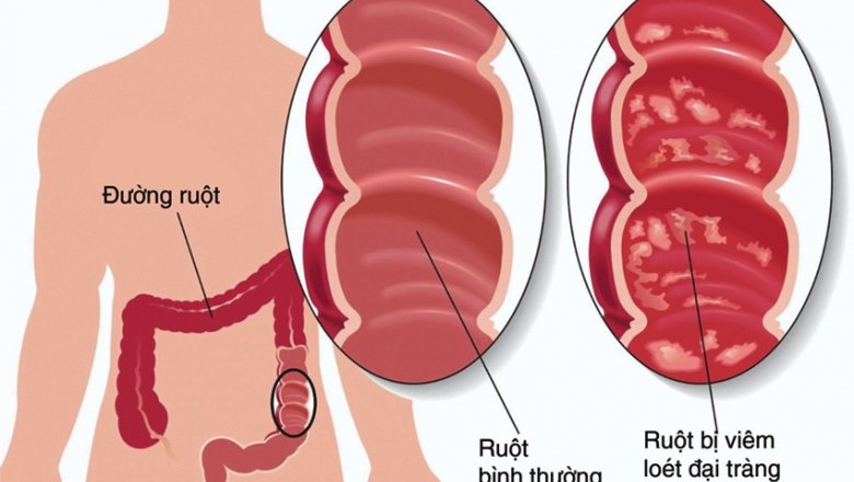 Viêm đại tràng, Nguyên nhân, Triệu chứng, Phòng và Điều trị bệnh Viêm Đại Tràng Mạn Tính