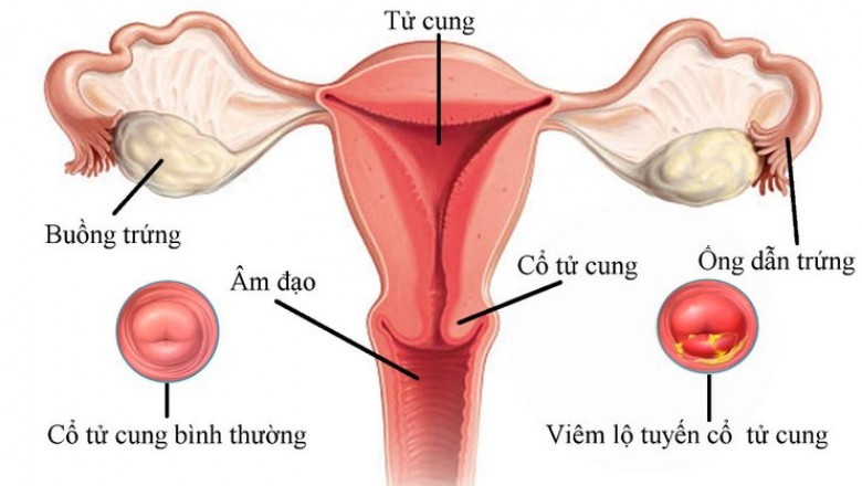 Nhiều phụ nữ bị viêm lộ tuyến cổ tử cung mà không biết