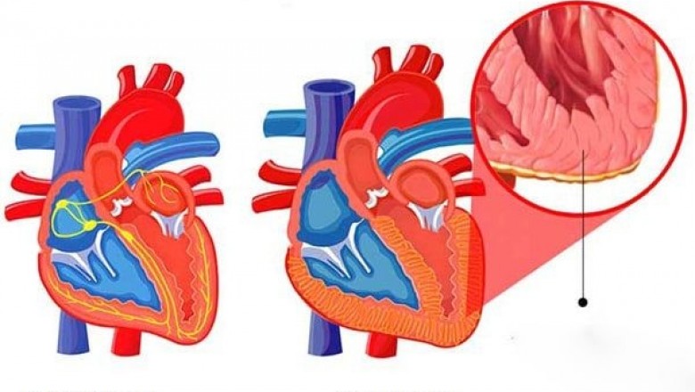 Bệnh Viêm cơ tim các dấu hiệu, triệu chứng, nguyên nhân, điều trị, cách phòng tránh