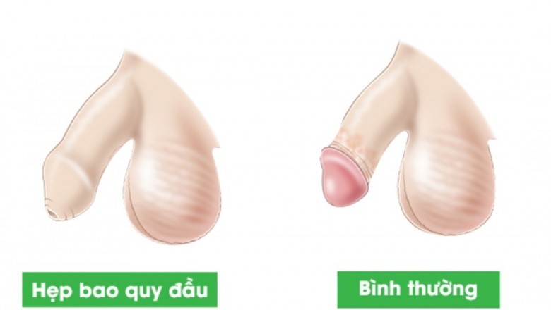 Bôi thuốc gì giúp trẻ nong bao quy đầu?