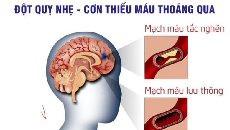 Ở Việt Nam chết do đột quỵ nhiều hơn ung thư: BS khuyến cáo những người sau có nguy cơ cao đột quỵ