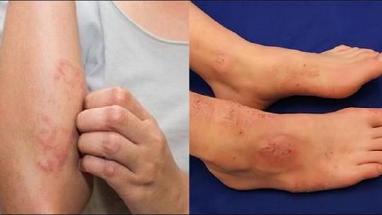 Nguyên nhân gây viêm da cơ địa và cách điều trị