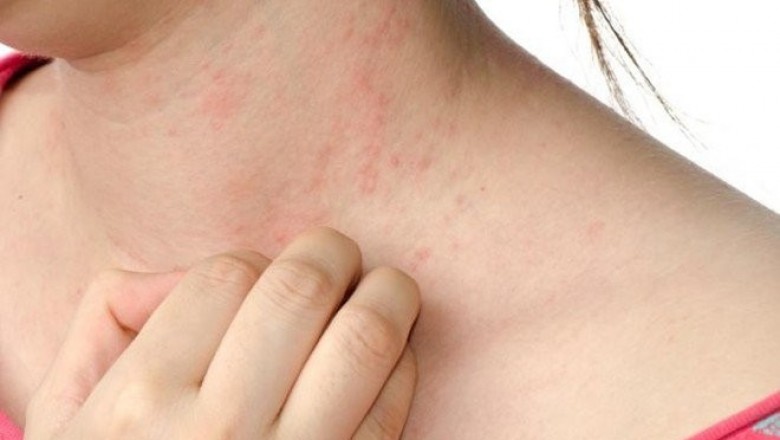 Ngứa khi trời lạnh, vì sao?
