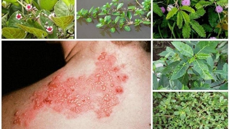 Các bài thuốc Đông y chữa zona thần kinh an toàn hiệu quả ngay tại nhà