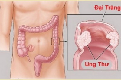 Thực phẩm phục hồi sức khỏe bệnh nhân ung thư đại tràng