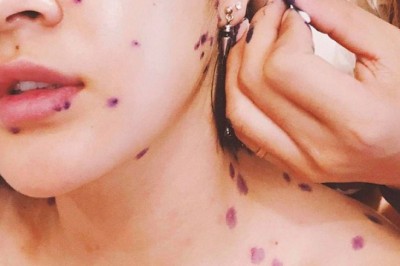 Bệnh thủy đậu ở người lớn và những biến chứng nguy hiểm khó lường