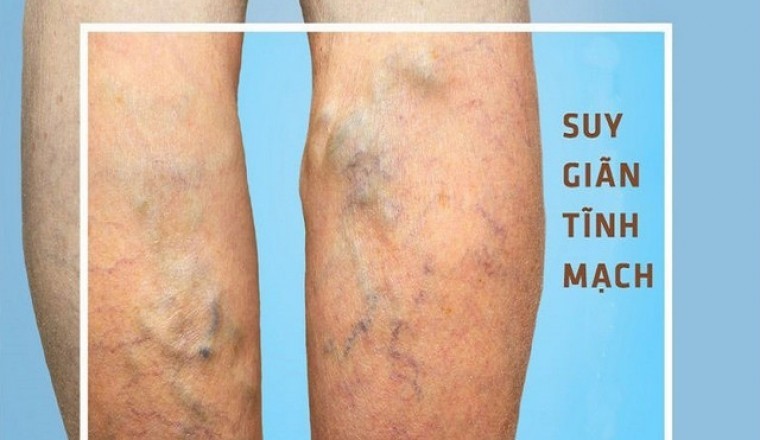 Suy giãn tĩnh mạch, ngâm chân thế nào?