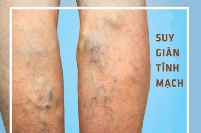 Suy giãn tĩnh mạch, ngâm chân thế nào?